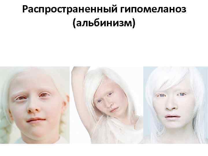Распространенный гипомеланоз (альбинизм) 