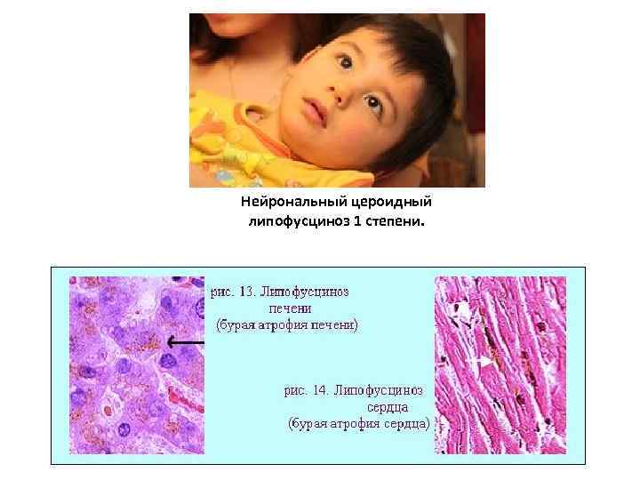 Нейрональный цероидный липофусциноз 1 степени. 