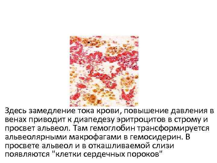 Здесь замедление тока крови, повышение давления в венах приводит к диапедезу эритроцитов в строму