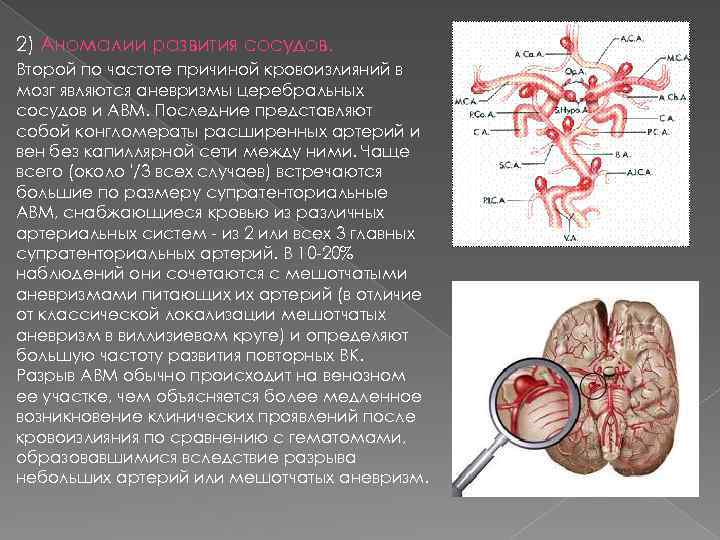 2) Аномалии развития сосудов. Второй по частоте причиной кровоизлияний в мозг являются аневризмы церебральных