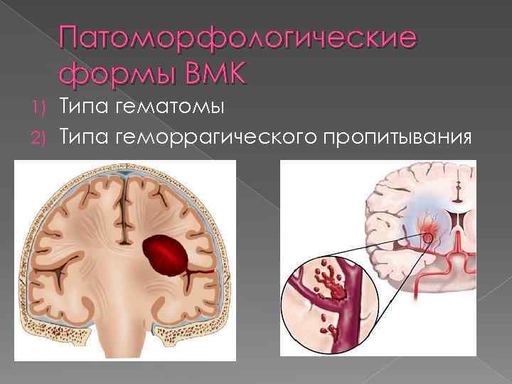 Патоморфологические формы ВМК Типа гематомы 2) Типа геморрагического пропитывания 1) 
