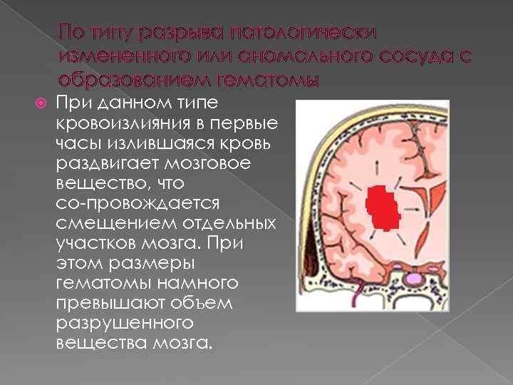 По типу разрыва патологически измененного или аномального сосуда с образованием гематомы При данном типе