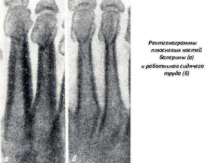 Рентгенограммы плюсневых костей балерины (а) и работников сидячего труда (б) 