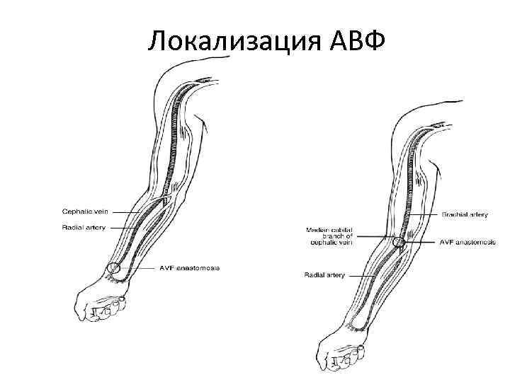 Локализация АВФ 