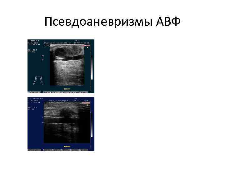 Псевдоаневризмы АВФ 