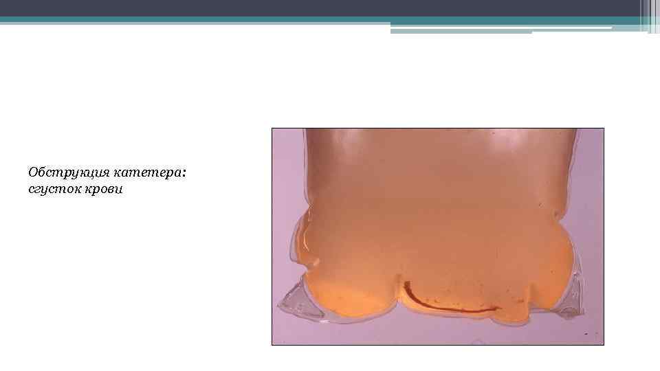 Обструкция катетера: сгусток крови 