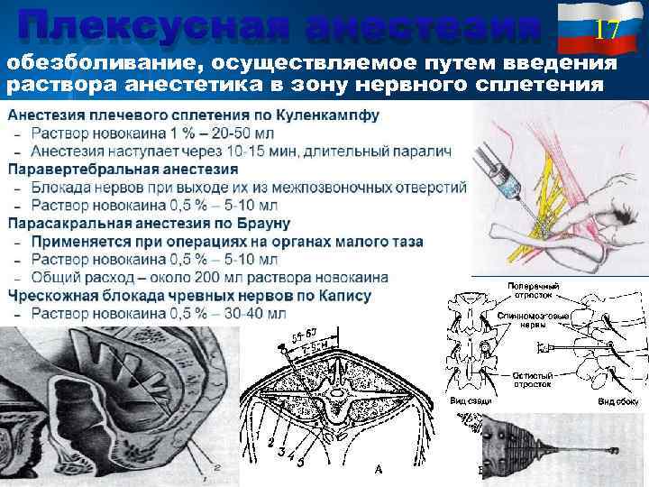 Плексусная анестезия 17 обезболивание, осуществляемое путем введения раствора анестетика в зону нервного сплетения 