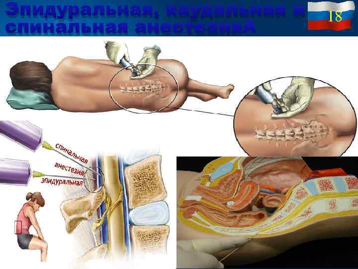 Эпидуральная, каудальная и спинальная анестезия 18 