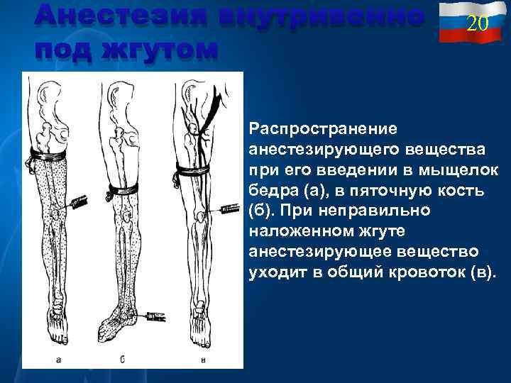 Анестезия внутривенно под жгутом 20 Распространение анестезирующего вещества при его введении в мыщелок бедра