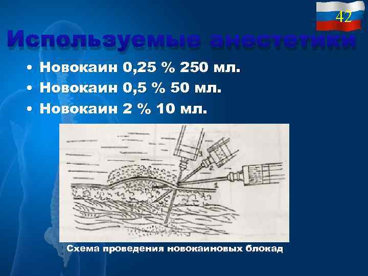 42 Используемые анестетики • Новокаин 0, 25 % 250 мл. • Новокаин 0, 5