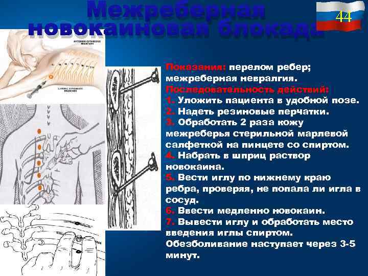 Межреберная новокаиновая блокада 44 Показания: перелом ребер; межреберная невралгия. Последовательность действий: 1. Уложить пациента