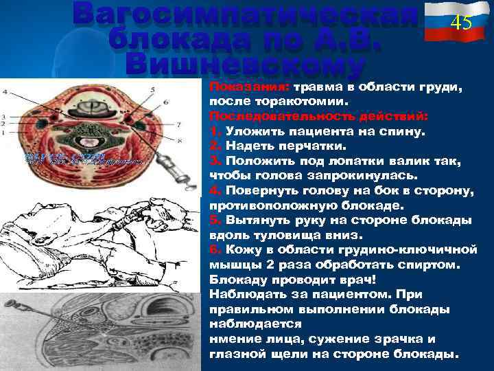 Вагосимпатическая 45 блокада по А. В. Вишневскому Показания: травма в области груди, после торакотомии.