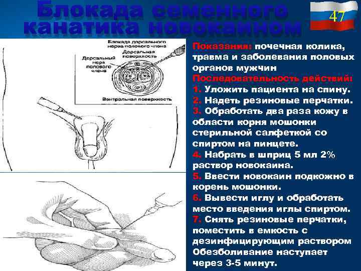 Блокада семенного канатика новокаином 47 Показания: почечная колика, травма и заболевания половых органов мужчин