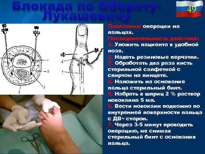 Блокада по Оберсту. Лукашевичу операции на Показания: 49 пальцах. Последовательность действий: 1. Уложить пациента