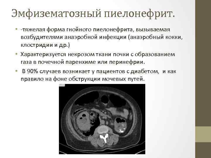 Эмфизематозный пиелонефрит. • -тяжелая форма гнойного пиелонефрита, вызываемая возбудителями анаэробной инфекции (анаэробный кокки, клостридии