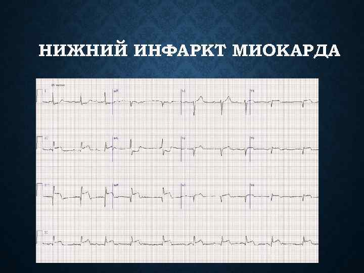 Неспецифические изменения st t нижней стенки лж