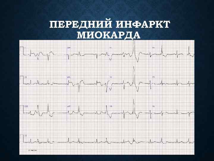 ПЕРЕДНИЙ ИНФАРКТ МИОКАРДА 