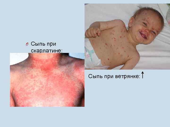 O Сыпь при скарлатине: Сыпь при ветрянке: 