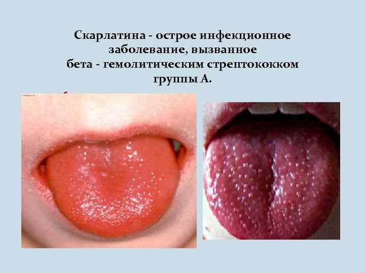 Скарлатина - острое инфекционное заболевание, вызванное бета - гемолитическим стрептококком группы А. O 
