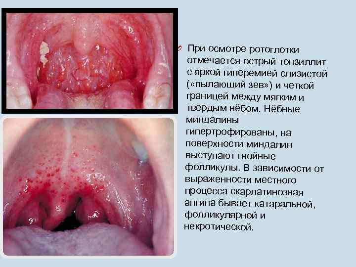 O При осмотре ротоглотки отмечается острый тонзиллит с яркой гиперемией слизистой ( «пылающий зев»