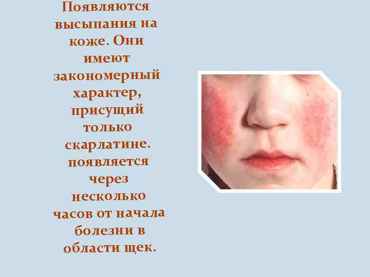 Появляются высыпания на коже. Они имеют закономерный характер, присущий только скарлатине. появляется через несколько