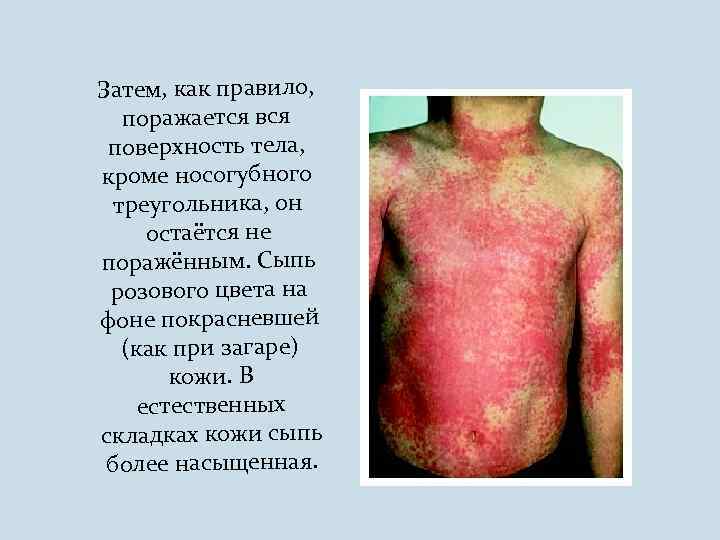 Затем, как правило, поражается вся поверхность тела, кроме носогубного треугольника, он остаётся не поражённым.