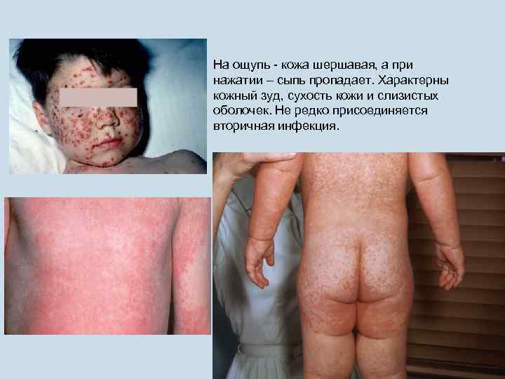 На ощупь - кожа шершавая, а при нажатии – сыпь пропадает. Характерны кожный зуд,