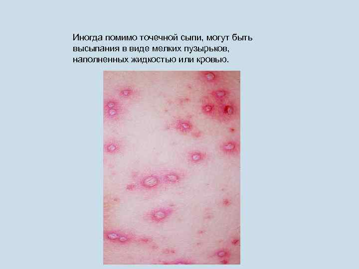 Иногда помимо точечной сыпи, могут быть высыпания в виде мелких пузырьков, наполненных жидкостью