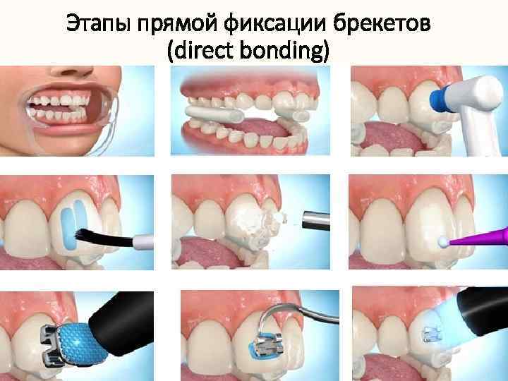 Этапы прямой фиксации брекетов (direct bonding) 