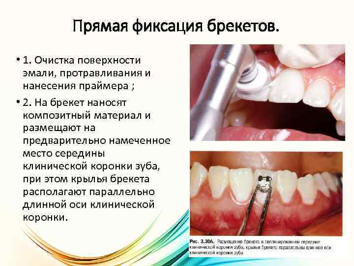 Прямая фиксация брекетов. • 1. Очистка поверхности эмали, протравливания и нанесения праймера ; •