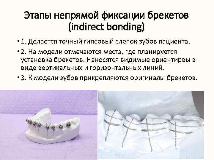 Этапы непрямой фиксации брекетов (indirect bonding) • 1. Делается точный гипсовый слепок зубов пациента.