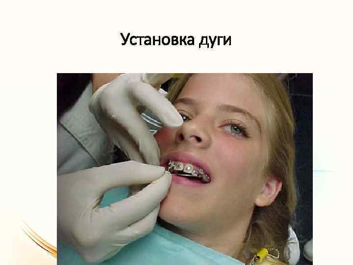 Установка дуги 