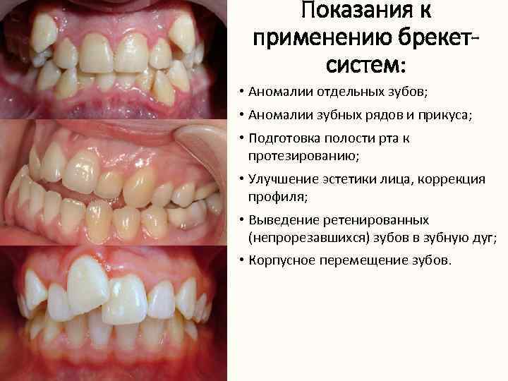 Показания к применению брекетсистем: • Аномалии отдельных зубов; • Аномалии зубных рядов и прикуса;