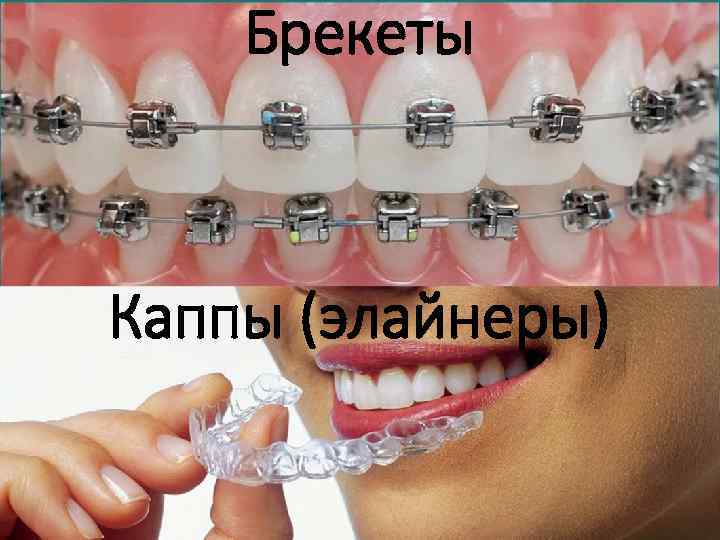 Брекеты Каппы (элайнеры) 