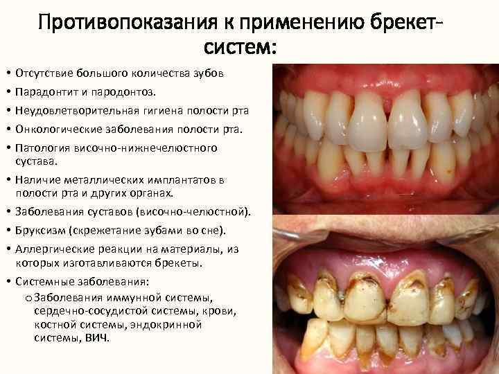 Противопоказания к применению брекетсистем: • • • Отсутствие большого количества зубов Парадонтит и пародонтоз.