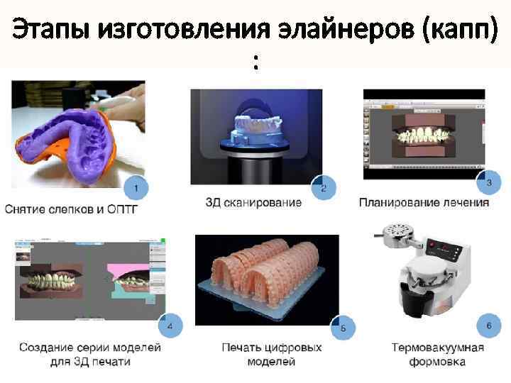 Этапы изготовления элайнеров (капп) : 