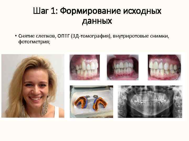 Шаг 1: Формирование исходных данных • Снятие слепков, ОПТГ (3 Д-томография), внутриротовые снимки, фотогметрия;