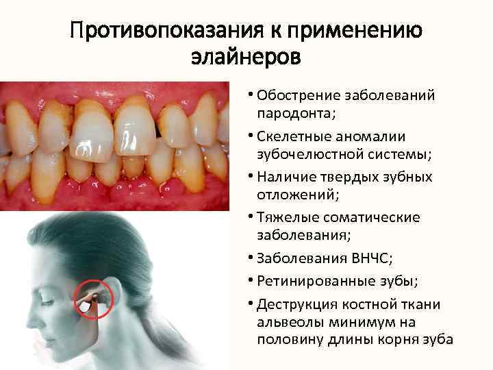 Противопоказания к применению элайнеров • Обострение заболеваний пародонта; • Скелетные аномалии зубочелюстной системы; •