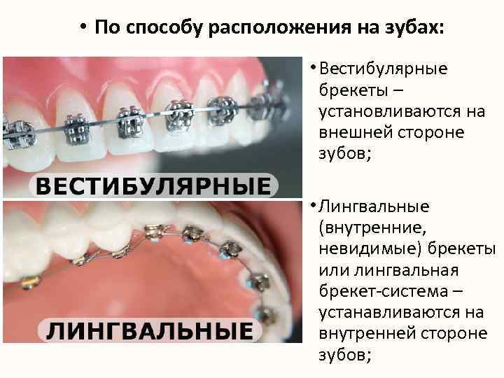  • По способу расположения на зубах: • Вестибулярные брекеты – установливаются на внешней