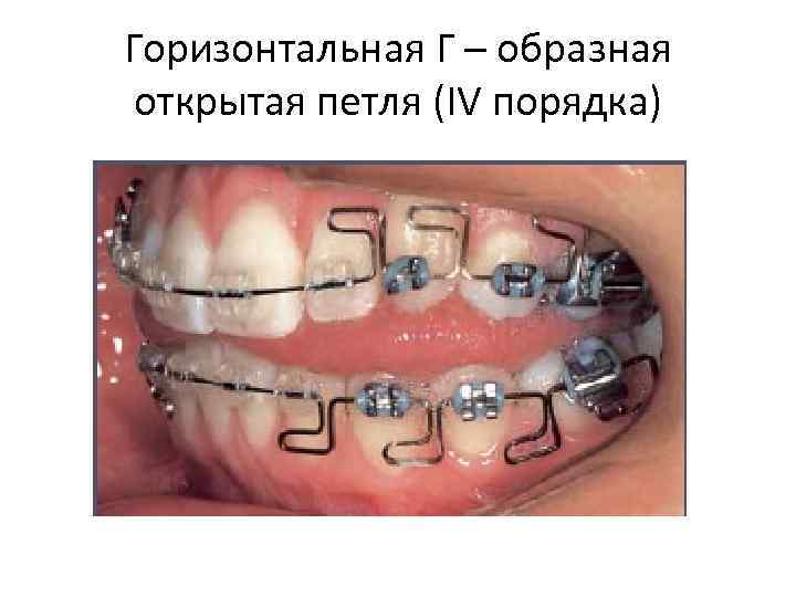 Горизонтальная Г – образная открытая петля (IV порядка) 