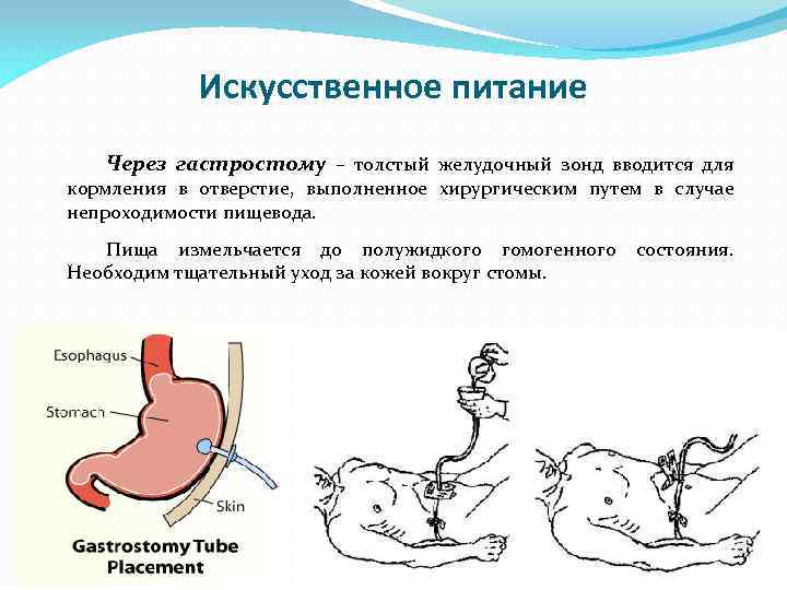 Искусственное питание Через гастростому – толстый желудочный зонд вводится для кормления в отверстие, выполненное