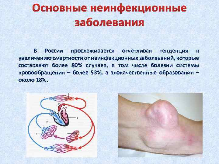 Основные неинфекционные заболевания В России прослеживается отчётливая тенденция к увеличению смертности от неинфекционных заболеваний,