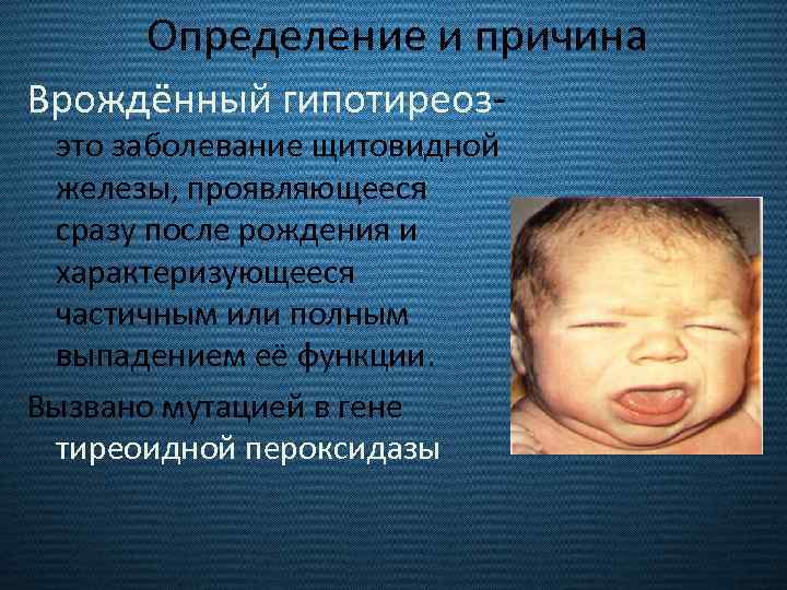 Определение и причина Врождённый гипотиреоз- это заболевание щитовидной железы, проявляющееся сразу после рождения и