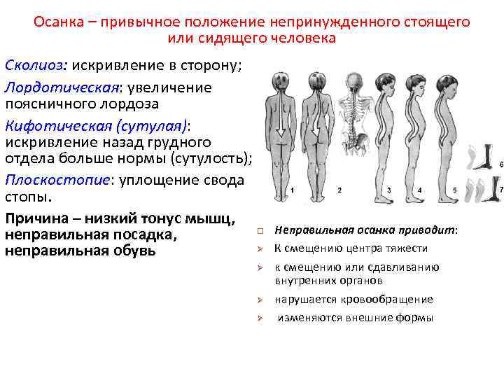 Осанка – привычное положение непринужденного стоящего или сидящего человека Сколиоз: искривление в сторону; Лордотическая:
