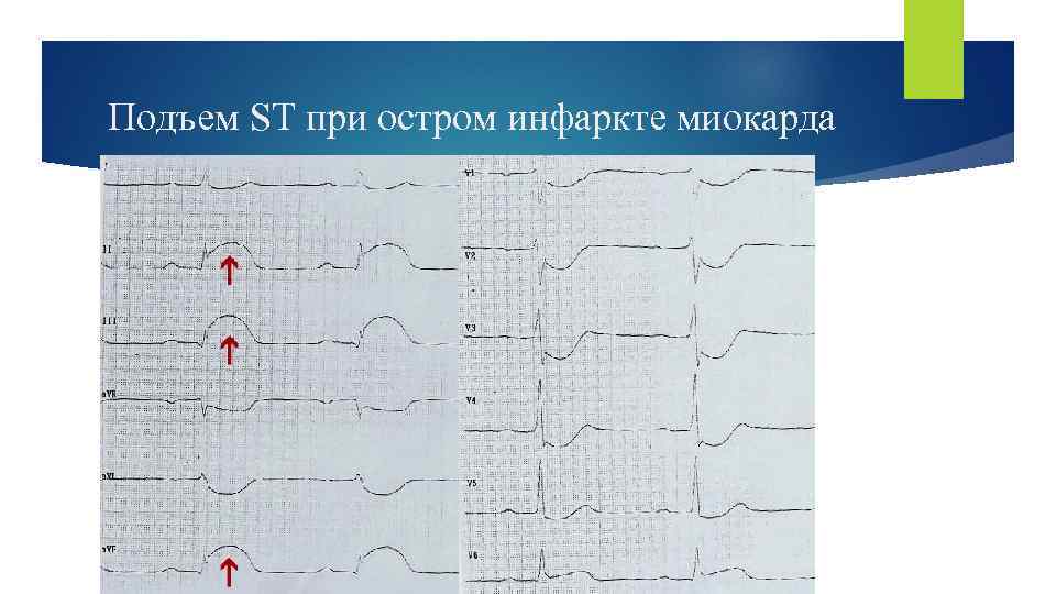 Подъем ST при остром инфаркте миокарда 