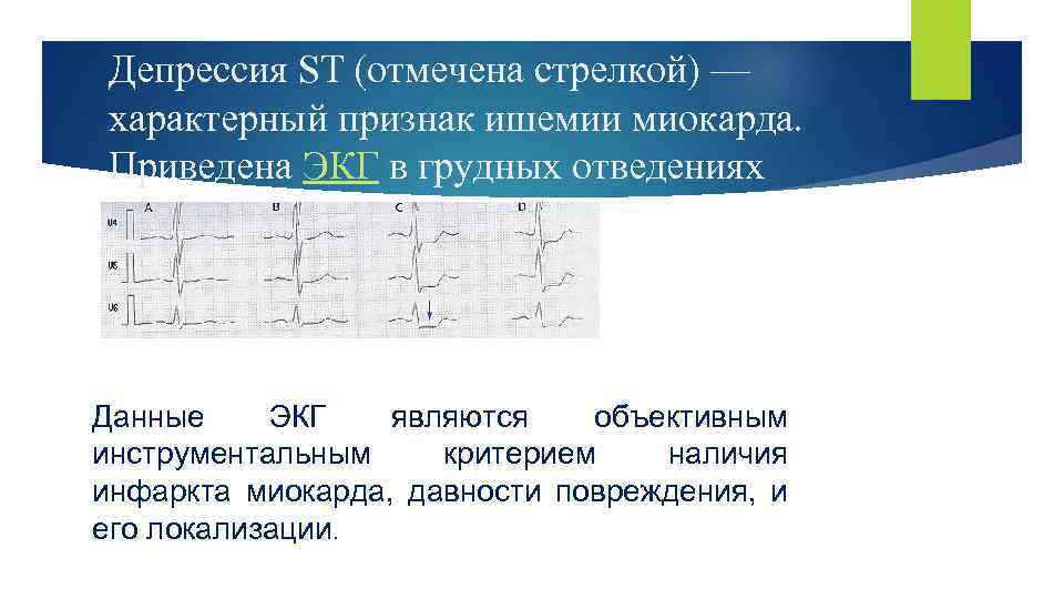 Депрессия ST (отмечена стрелкой) — характерный признак ишемии миокарда. Приведена ЭКГ в грудных отведениях