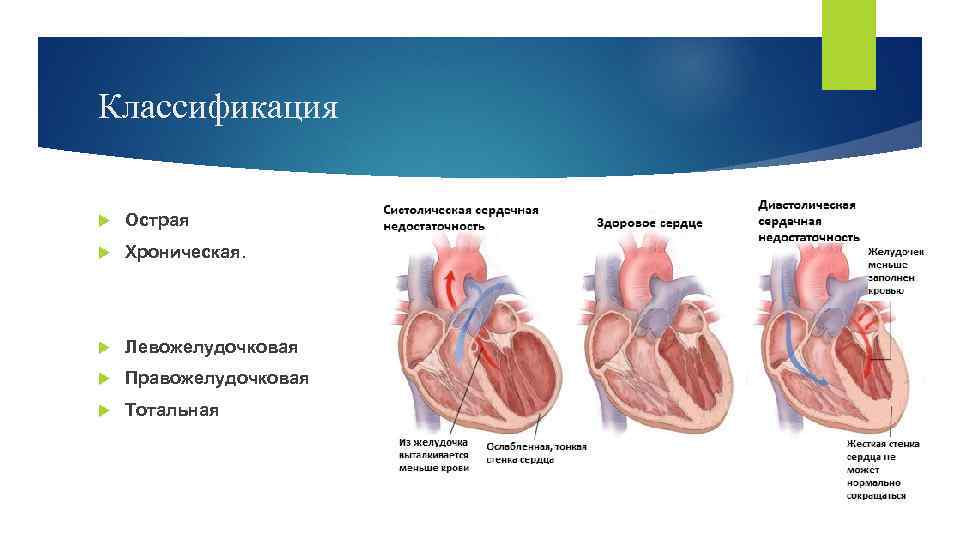 Острая правожелудочковая сердечная недостаточность презентация