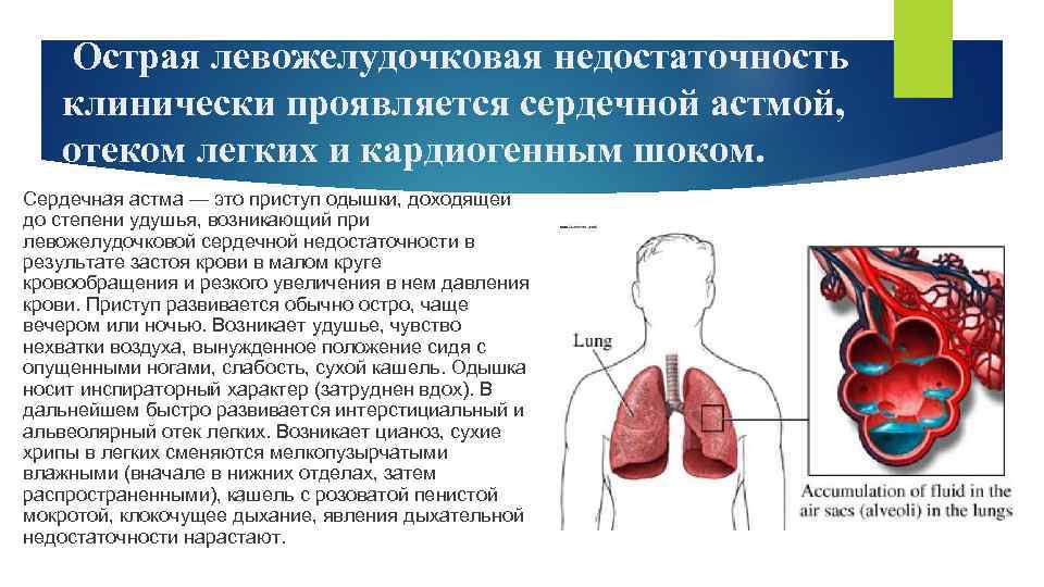 Острая левожелудочковая недостаточность клинически проявляется сердечной астмой, отеком легких и кардиогенным шоком. Сердечная астма