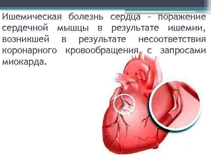 Ишемическая болезнь сердца – поражение сердечной мышцы в результате ишемии, возникшей в результате несоответствия