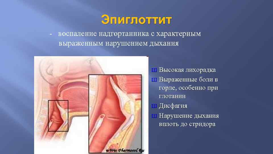 Эпиглоттит - воспаление надгортанника с характерным выраженным нарушением дыхания Высокая лихорадка Ш Выраженные боли